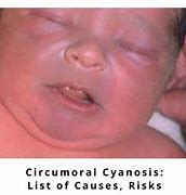 Image result for Cyanosis in Adults