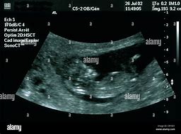 Image result for 3 Month Pregnancy Ultrasound