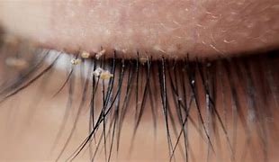 Image result for Eyelash Worms