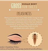 Image result for Eyelash Mites Symptoms