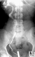 Image result for Retrocaval Surter Radiology