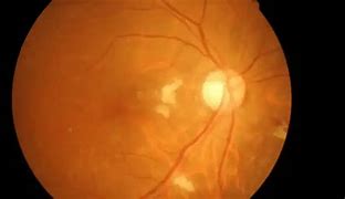 Image result for Enlarged Optic Nerve