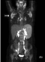 Image result for Pet Scan Lymphoma Example