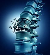 Image result for Lumbar Compression Burst Fractures