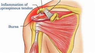 Image result for Supraspinatus and Infraspinatus Tendinopathy