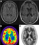 Image result for IRM Cerebrale