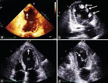 Image result for Sessile Thrombus