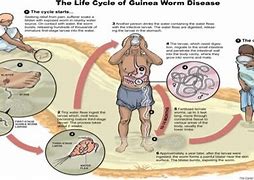 Image result for Dracunculiasis Treatment