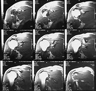 Image result for Shoulder MRI