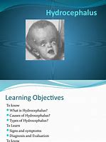 Image result for Hydrocephalus Concept Map