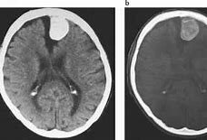 Image result for Subfalcine Meningioma CT