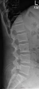 Image result for Lumbar Spine Side View