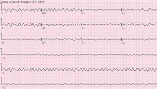 Image result for Course V-fib