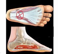 Image result for Plantar Fascia Rupture