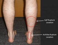 Image result for Tear in Calf Muscle