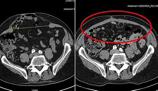 Image result for Cystoscope Botox