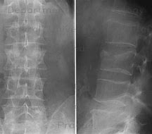 Image result for Imagees Compression Fracture of Lumbar Vertebrae