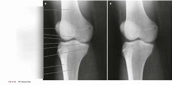 Image result for PA Oblique Lateral Rotation Knee