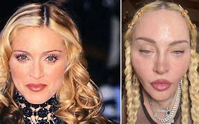 Image result for Madonna Today Plastic Surgery