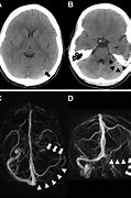 Image result for Sinus Thrombosis