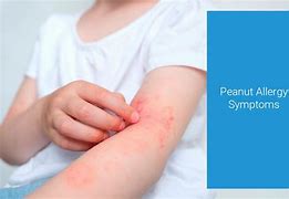 Image result for Peanut Butter Allergy Rash