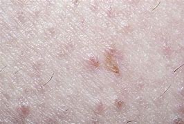 Image result for Ingrown Hair Causing Boils