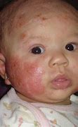 Image result for Baby Eczema Hands