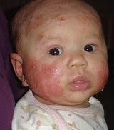 Image result for Eczema On Baby Arm