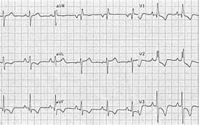 Image result for Right Ventricular Hypertrophy Echo