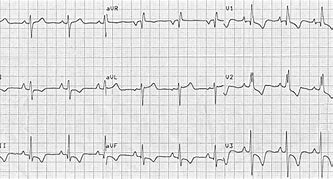 Image result for Right Ventricular Hypertrophy