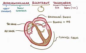 Image result for Atrioventricular Reciprocating Tachycardia