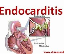 Image result for Acute Endocarditis