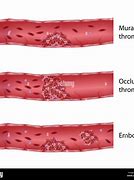 Image result for Sessile Thrombus