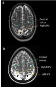 Image result for Ataxia MRI