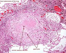 Image result for Necrosis Histology