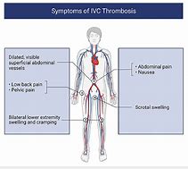 Image result for IVC Thrombs Post-Mortem