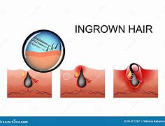 Image result for Ingrown Hair Pimple