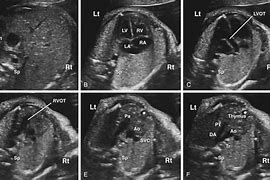 Image result for Rvot and LVOT Fetal Ultrasound Images Colour