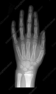 Image result for X-ray of Baby Hand