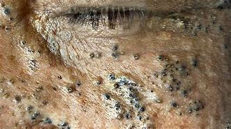 Image result for Pimples and Blackheads On Face