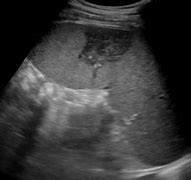 Image result for Spleen Infarction Ultrasound