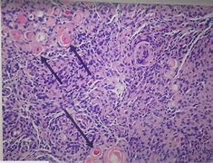 Image result for Medulloblastoma Location Diagram