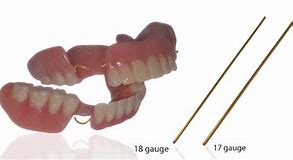 Image result for Acrylic Denture with Wrought Wire Clasps