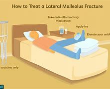 Image result for Lateral Malleolus Fracture Splint