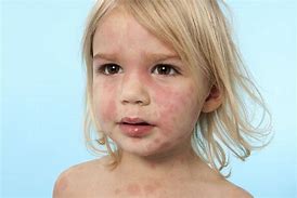 Image result for Baby Rash around Eyes