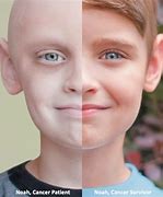 Image result for Cancer Affected Person