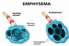 Image result for Emphysema