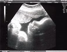 Image result for Head Circumference 37 Weeks Ultrasound