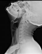 Image result for X-ray Bone Soft Tissue