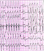 Image result for Polymorphic Wide Complex Tachycardia